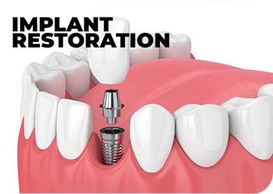 implant restoration.jpg