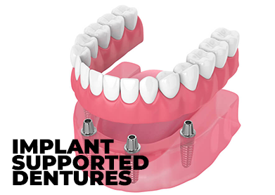 implant support dentures.jpg